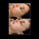 삼일공원로 | 아산 피부관리 가람뷰티 울트라 하이푸 3000샷 얼굴 관리 후기