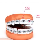 치아 교정 비용 총정리, 종류부터 기간까지