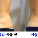 미세메뉴얼 지방흡입으로 매끄럽게 라인을 만드세요 이미지