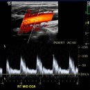 ICA stenosis 이미지