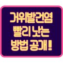 거위발건염 증상, 치료, 보호대 도움될까?(ft.5주 후기)