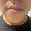 차플러스 | [공지] [포항 남자 레이저 제모] 젠틀맥스 프로 플러스 2회차 솔직후기