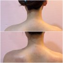 강서구 승모근관리 라운드 숄더로 말린 어깨 화곡역바디관리 피부를디자인하다 에스테틱