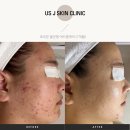 하단동137 | 사하구여드름관리ㅣ호르몬영향으로 인한 여드름 발생 개선후기