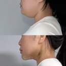 라이트성형외과의원 | 강남 이중턱살제거 근육묶기 내돈내산 일주일 변화 후기 리모성형외과