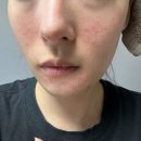 좁쌀 여드름 압출 후 관리까지 도와주는 여드름 스킨케어