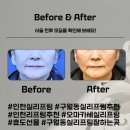효도한의원 | (인천 구월) 오마카세 실리프팅 인천실리프팅 잘하는 한의원
