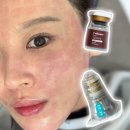 모공레이저 포텐자 + 스킨부스터 n회차 후기