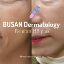 부산 피부과 리쥬란힐러 통증 때매 리쥬란Hb 플러스 맞고 이주일 지난 찐 후기