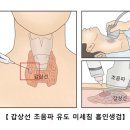 갑상선암 (Thyroid cancer) 이미지