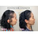 엘제이케이 | 여성 M자 탈모!? 부산두피문신잘하는곳 남포동두피문신 헤어라인두피문신