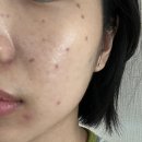 시티피부과의원 | 에코시티 다피네 의원 방문후기 낋여옴 🍜