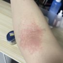 에스에이피부과의원 | [대전/노은] SA피부과의원, 알레르기 검사 비용, 너무 만족해서 쓰는 내돈내산 후기