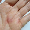 김태헌 | 청주 대상포진 초기 의심, 빠른 진단이 중요해요! 김태헌통증의학과 방문 후기