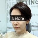 메이린조각술 조각주사 찐 후기 야금야금 예뻐지기 성공!