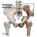 대퇴골두무혈성괴사 증상과 원인 이미지