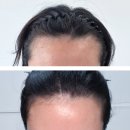 디자인선 | 강동구] 만족도 1000% 천호 두피문신 헤어라인 후기: 안 하면 후회하는, 비타SMP 추천