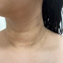 울산 목주름필러(바이리즌) / 울산 브이로어드밴스 / 울산 눈썹문신