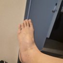 허준한방병원 | [발목인대파열] 1. 전거비/종비 인대 완전 파열 진단 (수술 병원 찾기)