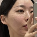 대구 동성로피부과 리즈네 스킨부스터 효과 엠보 경과 후기