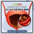 '요로 결석' 치료 특징 & 예방법 이미지