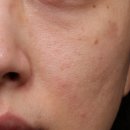 흥도초등학교 | 덕양구피부과 스킨부스터 후기｜모공·피부결·속건조 고민으로 리투오 선택한 이유