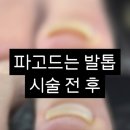 앙뚜네일 | ᰔ부산 용호동 네일 | 내성발톱, 늦기 전에 꼭 확인하세요ᰔ