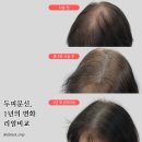 이미지헤어라인 | 우장산두피케어 소개팅 전 이미지 정리용 헤어라인 시술 후기
