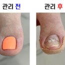 전주 문제성 발톱 내성발톱으로 아프면 레푸스 혁신점