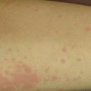 박진성 | 제목: 목동 콜린성두드러기, 따끔거리는 고통에서 벗어나신 환자분의 소중한 후기 (ft. 박진성 원장)