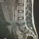 허리MRI 보시고 조언을~ 이미지