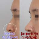 미사치유외과의원 | 용코교정, 콧구멍이 솟아있다면 이글 먼저 읽어보세요(강남 치유성형외과)