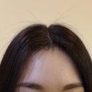 마이크로헤어증모 이미지