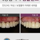 세종탑치과 네이버블로그