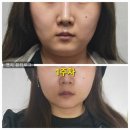 이중턱지방흡입 1주차 후기 후관리 하려면