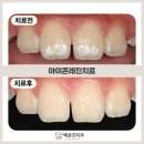 아이콘(icon)치과기공소 | 배곧동심미치료, 치아삭제없이 아이콘레진으로 탈회치료를