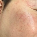 써니 | [결혼준비] 부천 상동 모공관리 찐 후기 (써니뷰티)