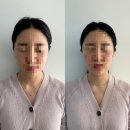 [광주/북구] 광주 티타늄(알테온) 리프팅 팔자 심부볼까지 싹 잡고 온 ‘제이샵뷰티’ 후기