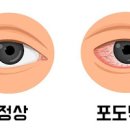 포도막염 원인 및 (눈충혈 날파리증 눈부심현상, 안구통증 오른쪽 왼쪽 눈통증) 이미지