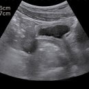 Congenital Adrenal hyperplasia 이미지