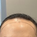 트렌디성형외과의원 | 대구 여자 헤어라인 모발이식 내돈내산: 병원8곳 발품 후기