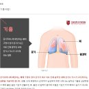 재발률 높은 &#39;기흉&#39; 언제 수술해야 할까? 이미지