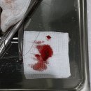 서울덴토피아치과의원 | 일산 임플란트 재수술 잘하는 서울덴토피아치과. 앞니 임플란트