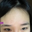 더라움의원 | 압구정 :: 라움성형외과의원 (흑자 &amp; 군집성 흑자 치료) 4개월 후 솔직후기(2) 예약 성공하는 방법...