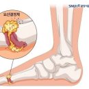 통풍 환자의 요산결정체 제거 이미지