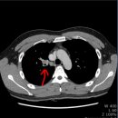 열방약국 | 비소세포폐암 선암 4기 EGFR 19del 치료 경과 공유 (1) 렉라자 리브리반트 병용요법 5개월차