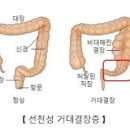 선천성 거대결장(히르슈슈프룽 병)이란? 원인과 의심 증상 이미지