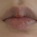 녹두한의원 | 4년간 고생한 구순염 완치후기