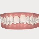 465 | 🌟 인비절라인 교정 후기🦷 (+465)