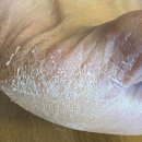 수성구 티눈 제거, 발 각질 관리 솔직 후기~